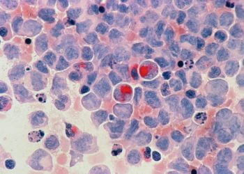 Eencelanalyse legt verschillen bij chronische lymfatische leukemie bloot