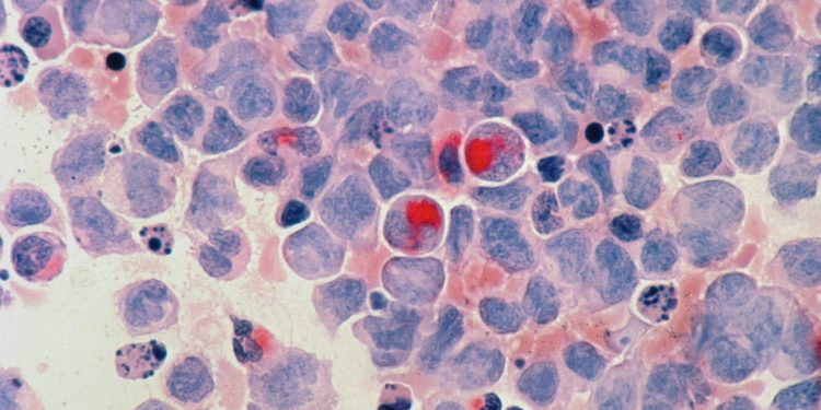 Eencelanalyse legt verschillen bij chronische lymfatische leukemie bloot